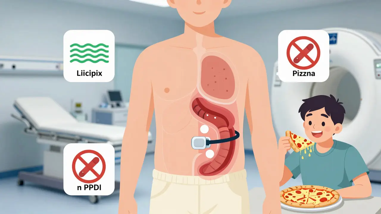 食道に磁石のリングを埋め込んだLINX手術の解剖図風イラスト。